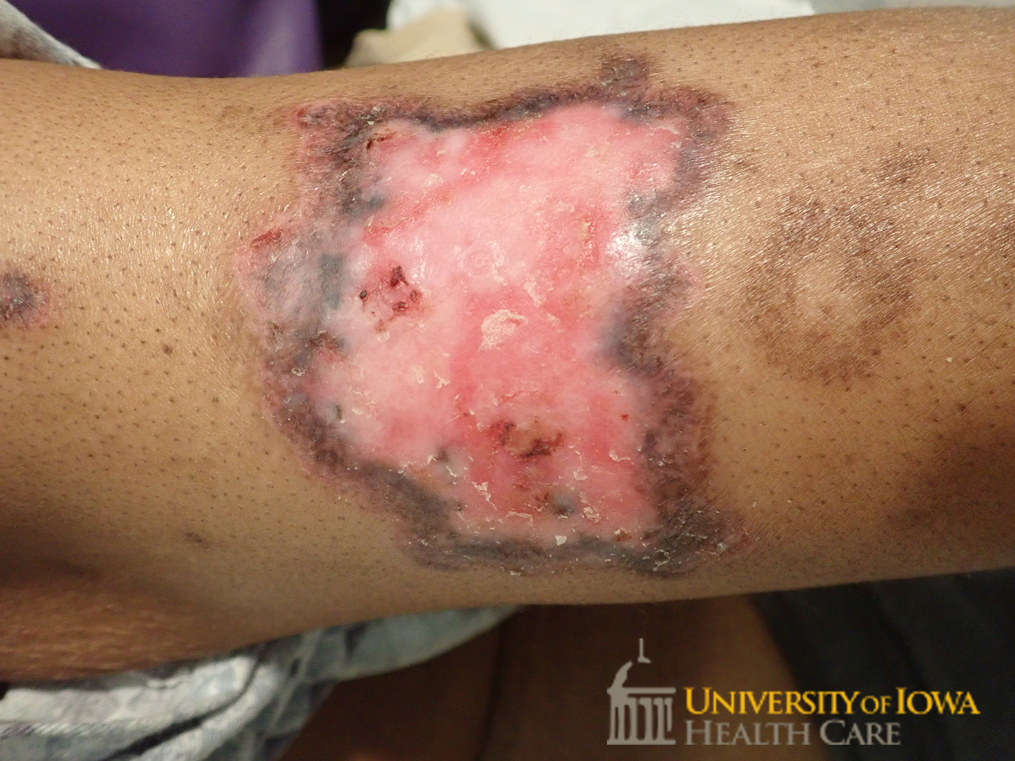 Shiny, atrophic plaques with central depigmentation and peripheral hyperpigmentation with rim of pink, scaly plaques on the extremity. (click images for higher resolution).
